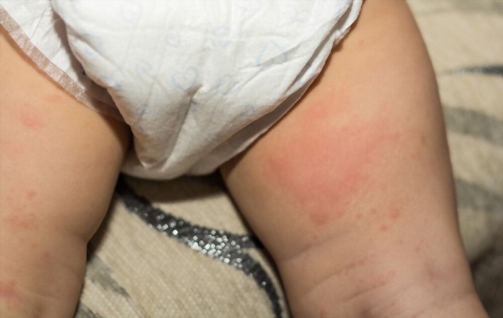 How Can I Use Cornstarch for Diaper Rash Treatment?