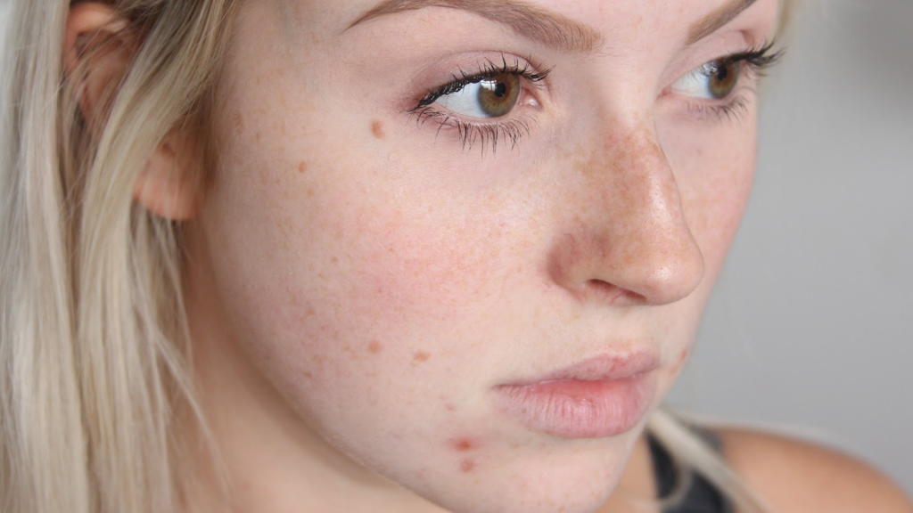 Acne Treatment – Great Ways To Clear Your Face Of Acne