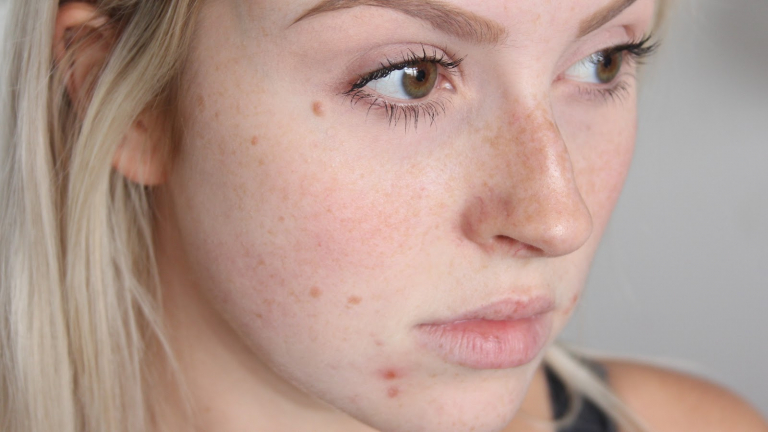 Acne Treatment – Great Ways To Clear Your Face Of Acne