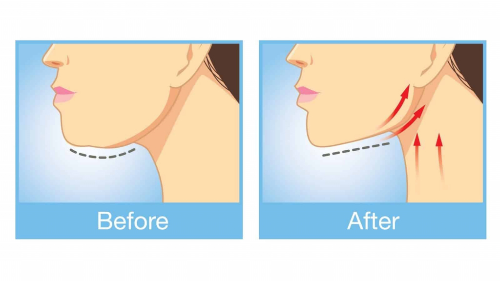 How to Get Rid of a Double Chin