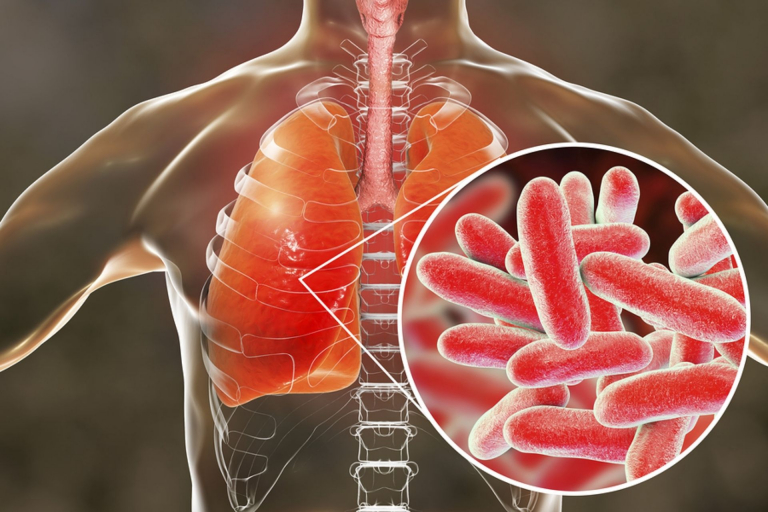 Legionnaires’ Disease: Everything You Need to Know