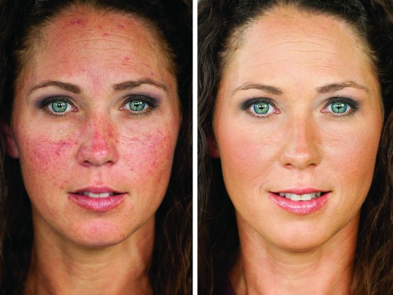 Looking for Rosacea Treatment in Sydney? Here are the Top 5 Clinics!