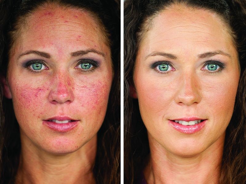 Looking for Rosacea Treatment in Sydney? Here are the Top 5 Clinics!
