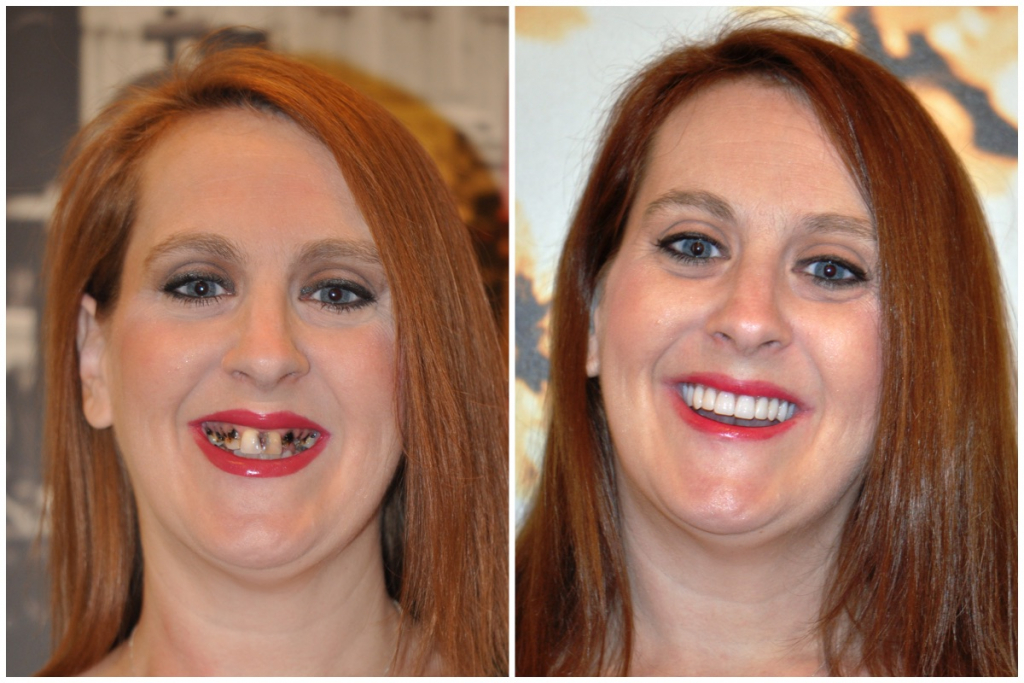 Dental Implants Are a Healthy Alternative to Dentures