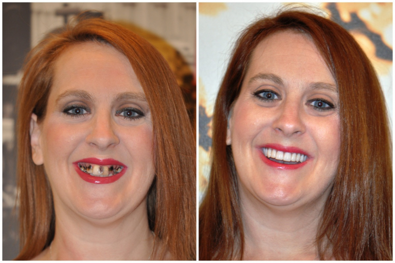 Dental Implants Are a Healthy Alternative to Dentures