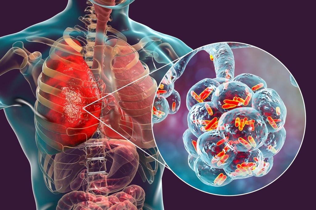 A Guide to Legionnaire’s Disease