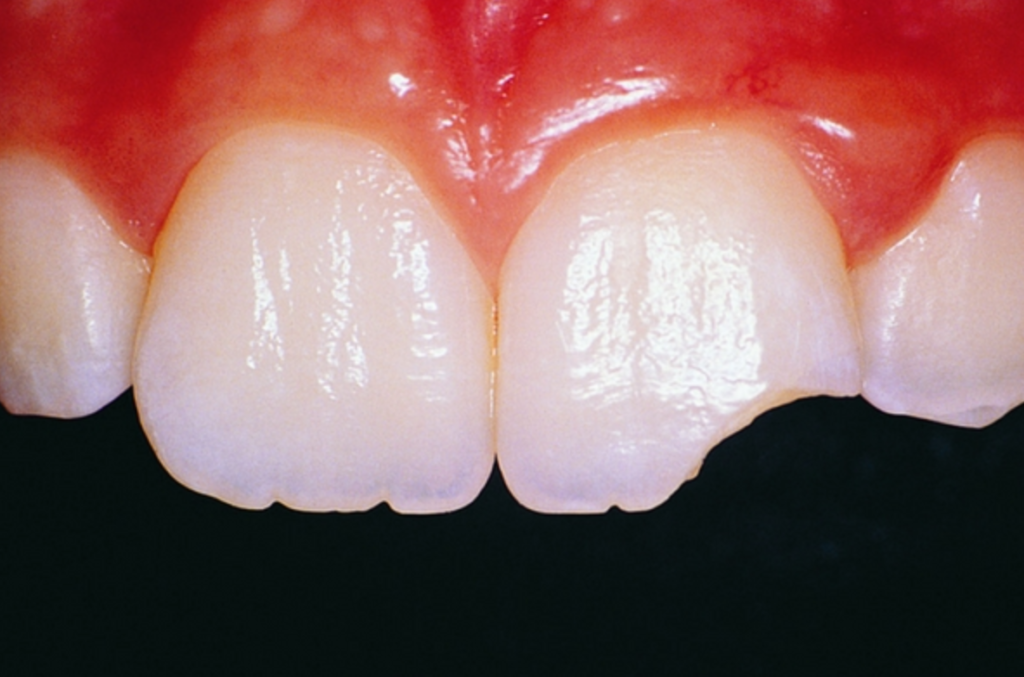 How to Handle Traumatic Injuries to Your Teeth in Brooklyn