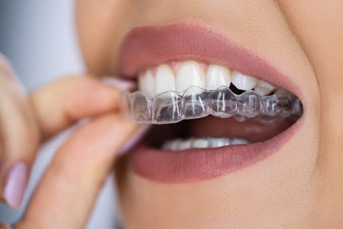 Why More Adults in Chino, CA Are Choosing Clear Aligners for a Straighter Smile in 2026